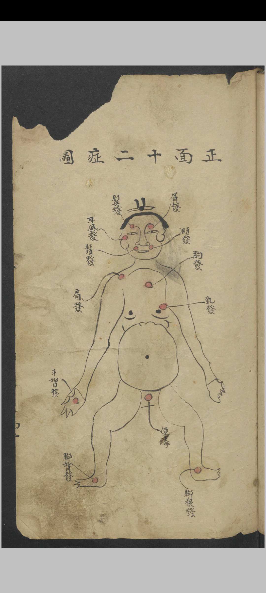 图片[7]-中华古籍网-专注古书收集外科图说及医方    1900-中华古籍网-专注古书收集中华古籍网-专注古书收集