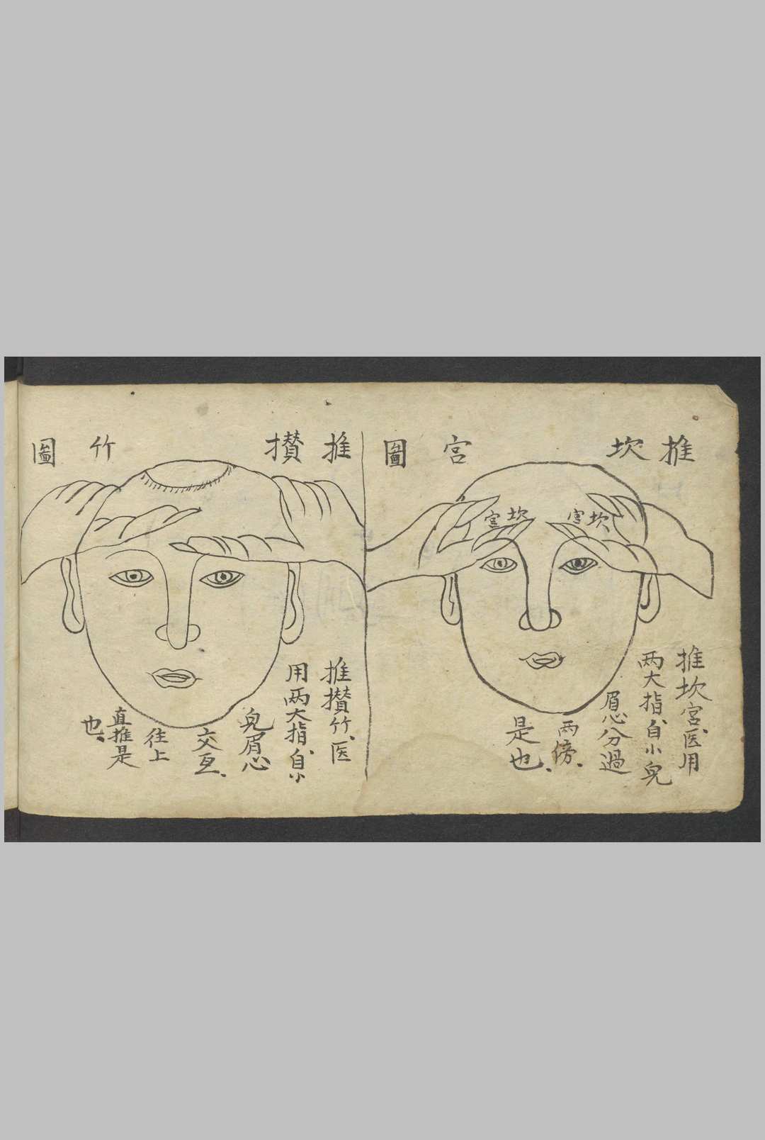 图片[19]-中华古籍网-专注古书收集熊应运 全抄小儿推拿广意 , 1900-中华古籍网-专注古书收集中华古籍网-专注古书收集